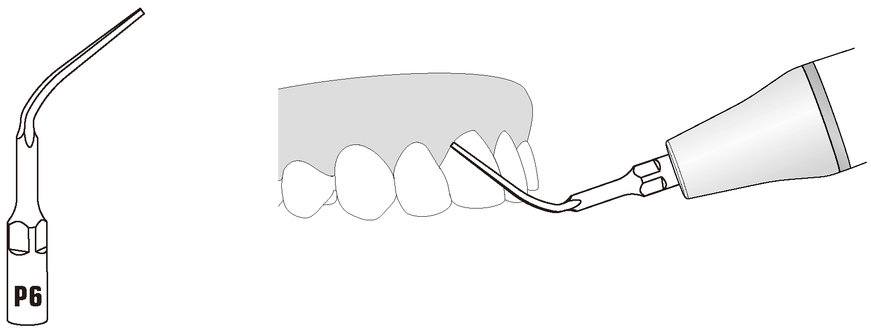 Сфера применения наконечника для скалера